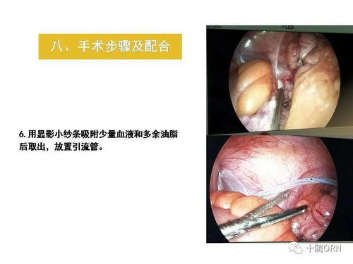 腹腔镜阑尾切除术围术期的护理