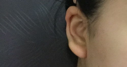 想问一下我的耳朵是元宝耳朵吗 怎么会这样 