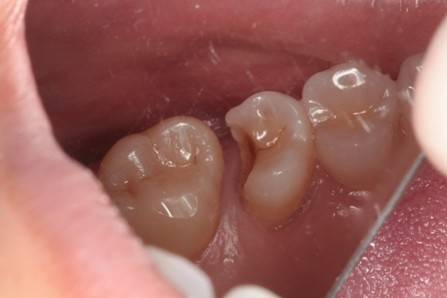 为什么补牙的材料会脱落 是不是医生技术不行