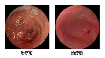 胃炎 胃溃疡反复,要注意杀菌 