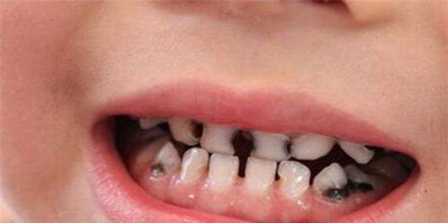 孩子牙齿可能会出现哪些问题 你或许真的不知道,看育儿专家理解