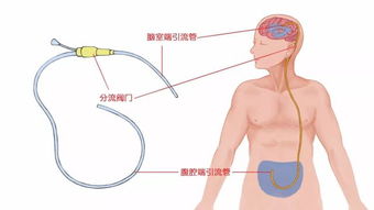 老来糊涂未必真 糊涂 你了解老年性正常颅压脑积水吗 原创