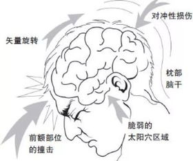 散打拳手在遭遇头部重击KO后会暂时性失忆,是真的吗