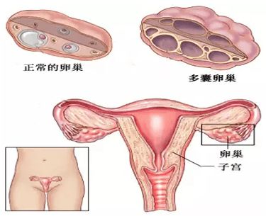 明日直播预告 多囊精准调理方案解析