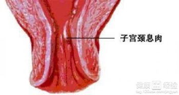 子宫内膜息肉做阴道B超有什么好处