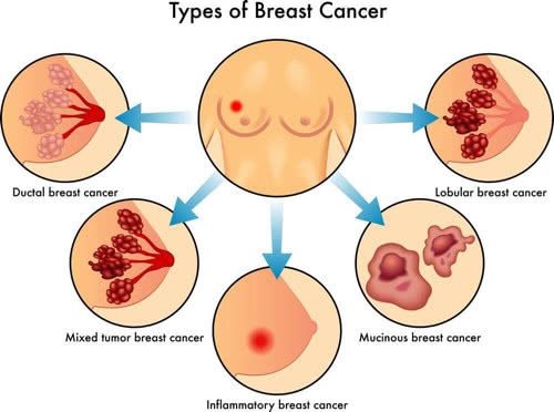 乳腺癌的预后怎样 治疗原则是什么