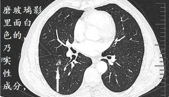 从CT看肺癌病理分型 如何用肺CT装酷 LOOK