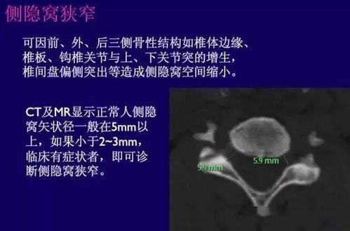 脊索瘤诊断及治疗专家建议手册？颅内脊索瘤如何治疗(颅内脊索瘤治愈率)