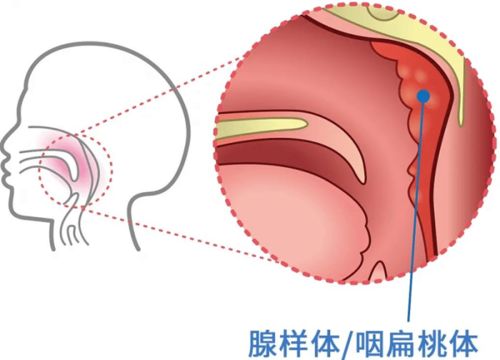 什么是腺样体肥大？