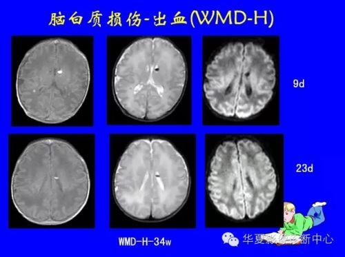 如何判断新生儿脑部核磁共振片子是否正常？