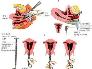高清图解女人子宫贞操带全过程