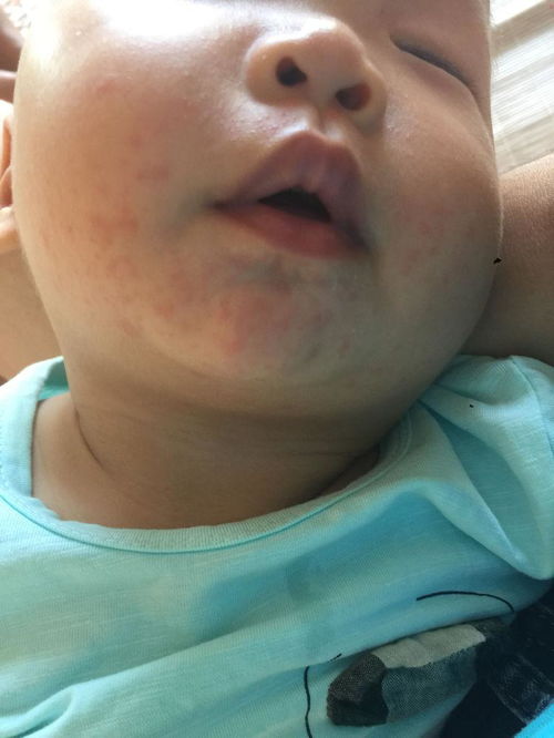 婴儿脸上起湿疹，婴儿脸上长红疹子是怎么回事