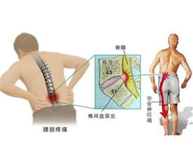 腰腿疼痛脚麻无力,你必须知道的腰突知识