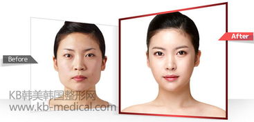 改脸型手术有哪些方法