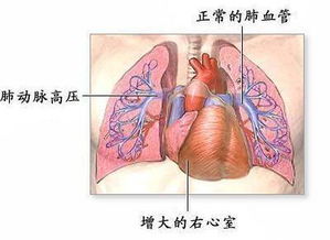 肺动脉高压*,什么是肺动脉高压
