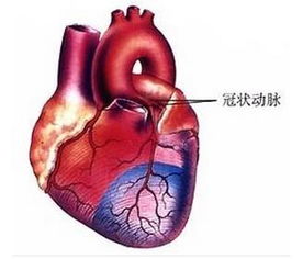 冠状动脉硬化最好的治疗方法(动脉硬化最怕三种水果)