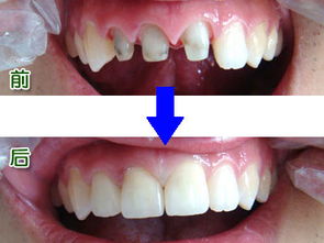 二氧化锆全瓷牙修复牙齿的效果好不好