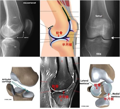 膝关节软骨损伤图片 搜狗图片搜索