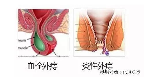 肛门疼痛,一定就是痔疮