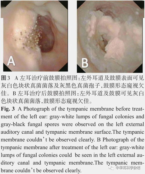 外耳道真菌病例图片 搜狗图片搜索