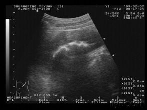 双肾结石 供初学者