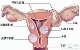 子宫肌瘤需要做手术治疗吗