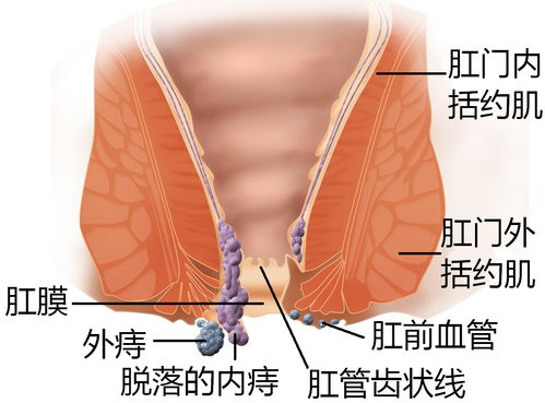 痔疮,连大文豪苏轼都难逃其手