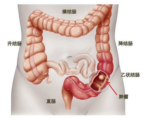 结直肠癌