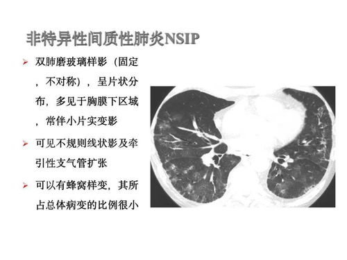 硬皮病 相关肺间质病变的治疗