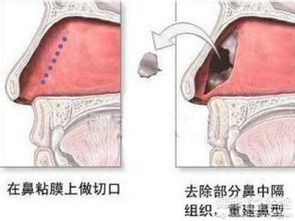 鼻中隔偏曲久拖不治有哪些危害