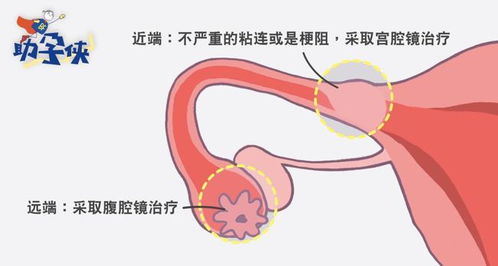 输卵管堵塞不通怎么办 输卵管通液,腹腔镜什么时候做