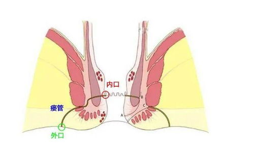 肛瘘找上门 看看自己犯了什么错