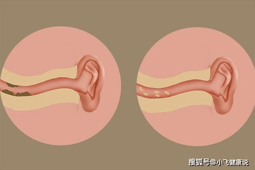 耳朵经常发痒,但掏不出东西 别再掏了,或是身体警示信号