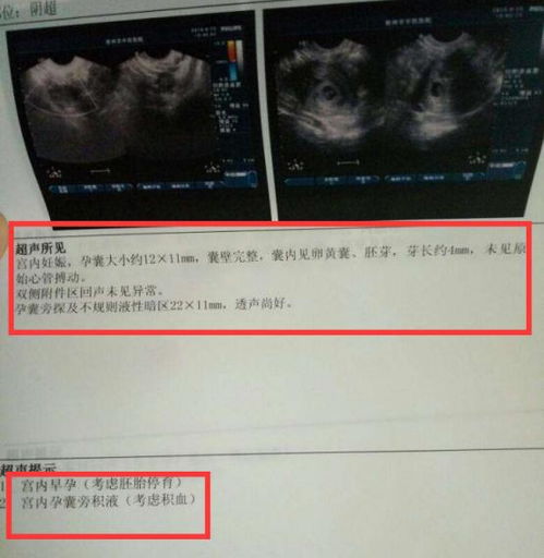 脱离王室的梅根二胎流产 如何避免无声的酷刑,写给胎停的姐妹