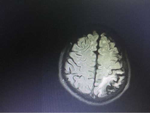 左颈内动脉闭塞致急性脑梗死介入治疗一例