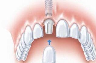 比一比种植牙和镶牙哪个会更好