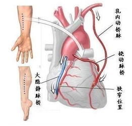 保卫心血管 冠脉CTA与冠脉造影选哪个好 