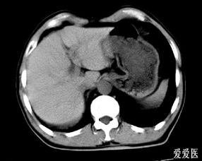 上腹部CT求教大家有问题没有