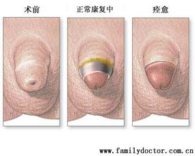 包皮手术 包皮环切基本常识