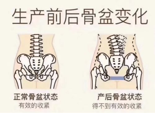 关于女性骨盆修复 你必须要知道的事儿