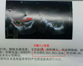 孕囊大小看宝宝性别是很准确的,不相信吗 