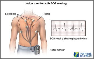 媲美心脏Holter 泰控心仪创造医疗奇迹