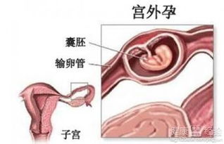 宫外孕腹腔镜手术治疗