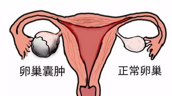 原创卵巢囊肿“惹祸”，使年轻女孩孕味十足，可能与这4个因素有关