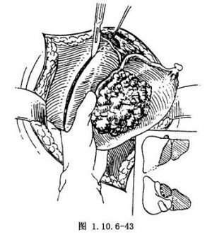 肝切除术