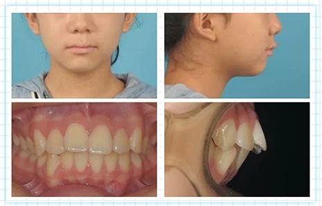 合生齿科正畸主任Dr.舒广拔牙 非拔牙 临界病例正畸分享