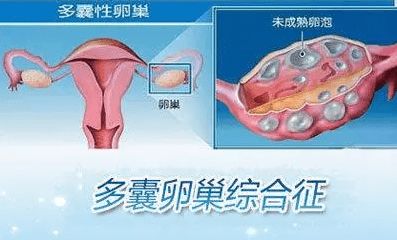 原创要想多囊卵巢综合征不上身，要重视防护！这3件事女性需要做到位