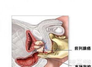 前列腺癌骨转移的治疗方法