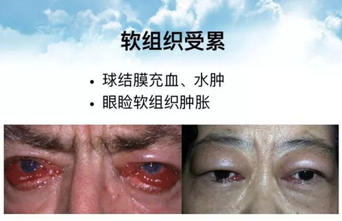 tao是什么病,Tao病的症状。