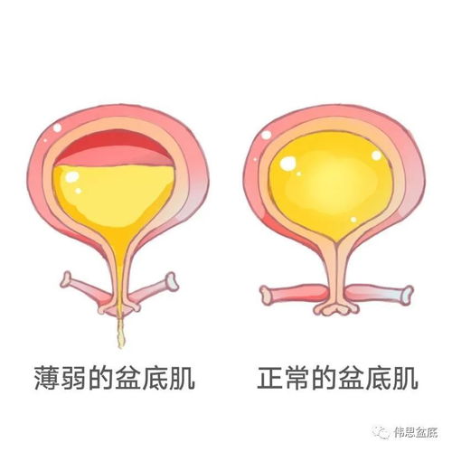 为什么要做盆底肌筛查 产后两年了做盆底康复有用吗